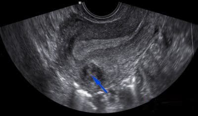 Imagem de ultrassom mostrando um mioma intramural assinalado na seta azul.
