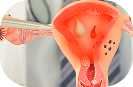 Endometrite e Hidrossalpinge