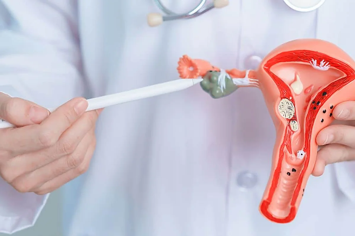 Endometriose E Mioma Uterino: Entenda A Diferença - Clínica Saphire