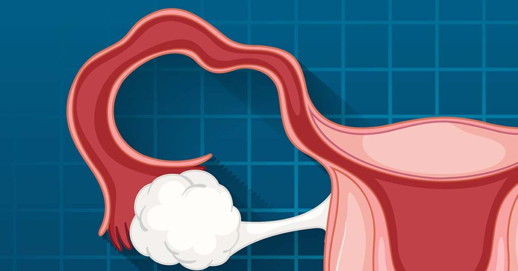 Salpingostomia: quando é indicada e quais são os limites para preservar a fertilidade?